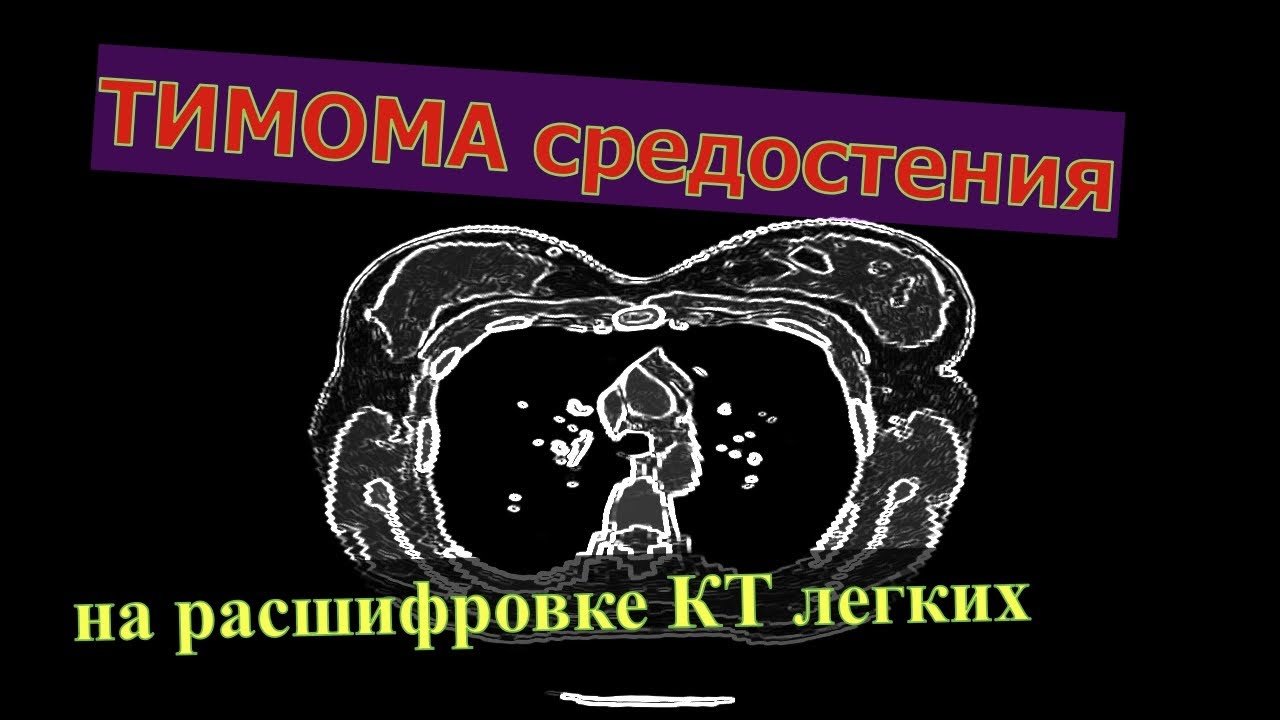 ТИМОМА средостения на РАСШИФРОВКЕ КТ легких онлайн.  ТИМОМА на КТ снимках.