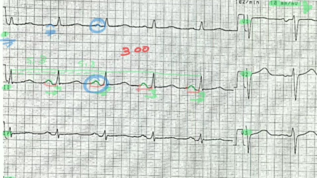 ECG de A à Z : exercice 3 + correction