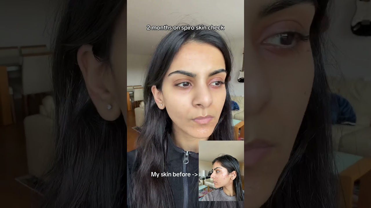 Two months on spironolactone skin check! #skincare #acne #dermatology #spiro