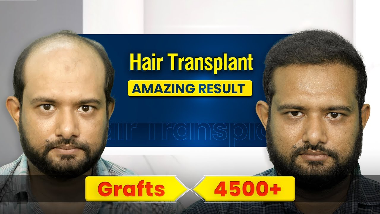Amazing 6 Month Result Reveal | 4500 Grafts | Grade 5 | Hairfree & Hairgrow Bangladesh