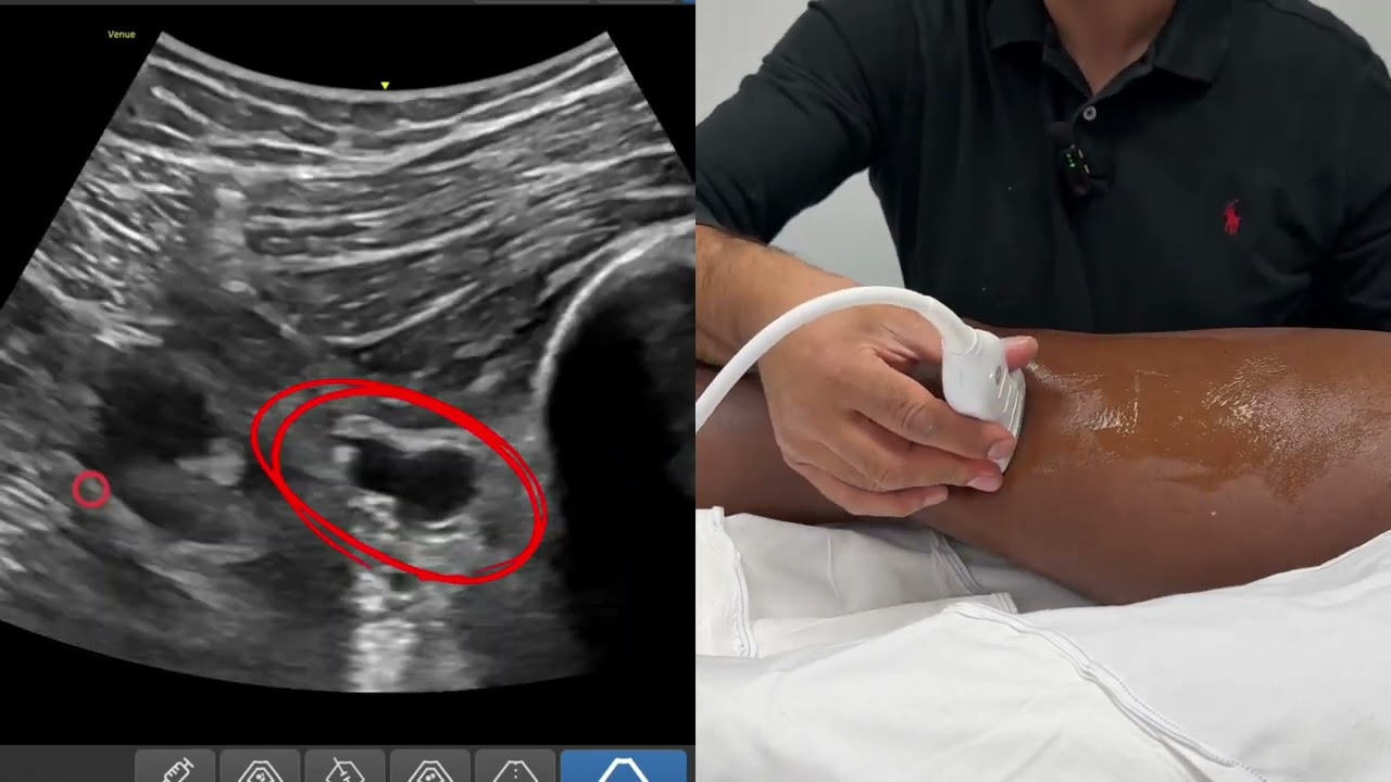 IPACK Block - Medial In-Plane Insertion