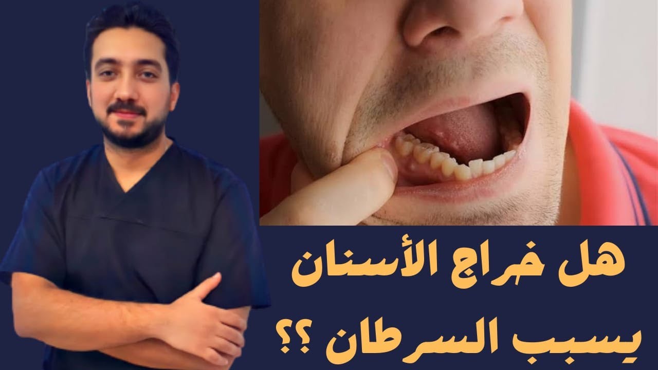 هل خراج الأسنان يسبب السرطان؟