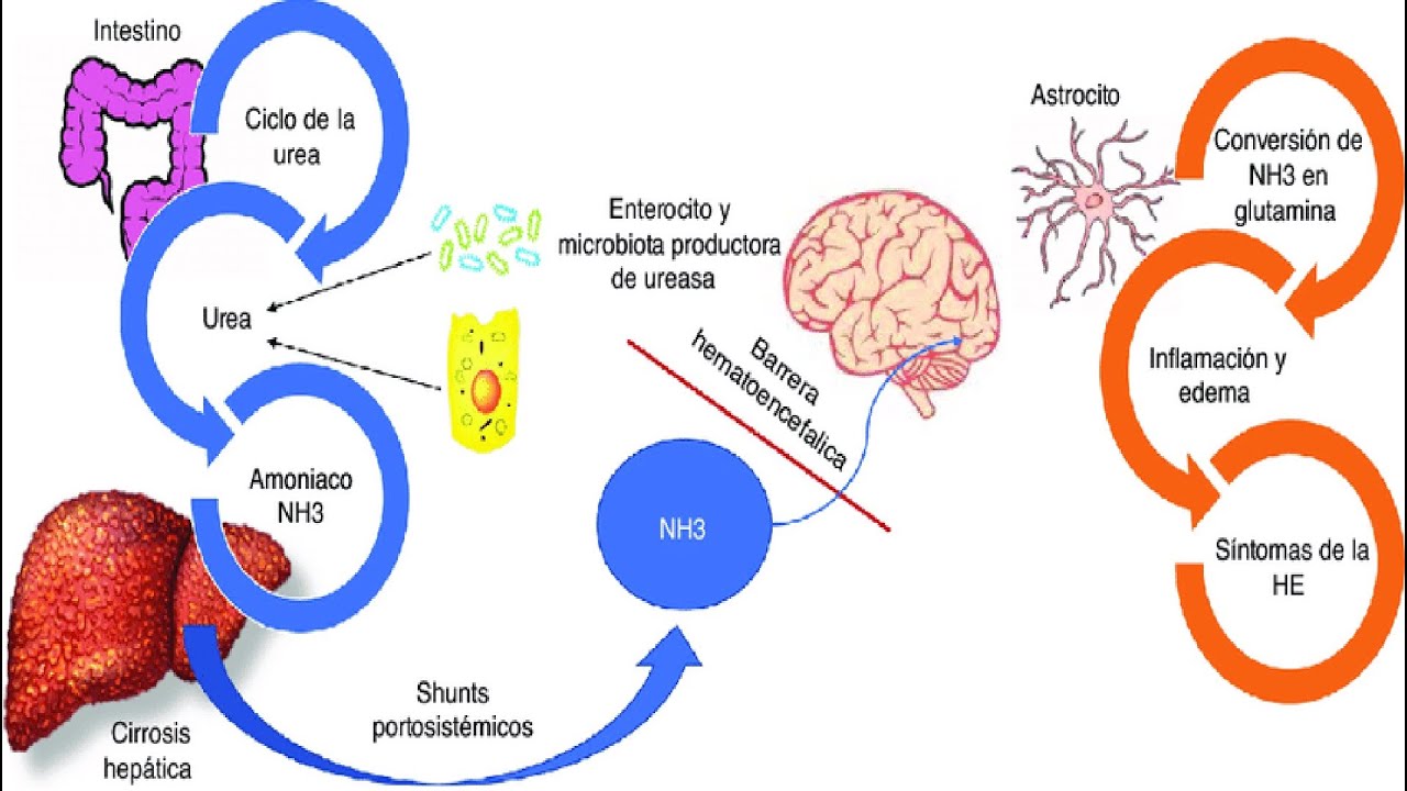 Encefalopatia hepática por cirrosis
