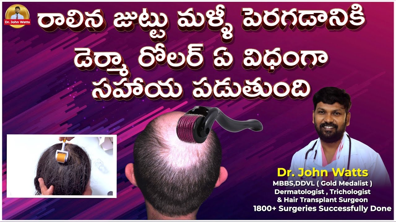 Derma Roller For Hair Growth | డెర్మా రోలర్ ఉపయోగించే విధానం | Dr.John Watts | Trichos