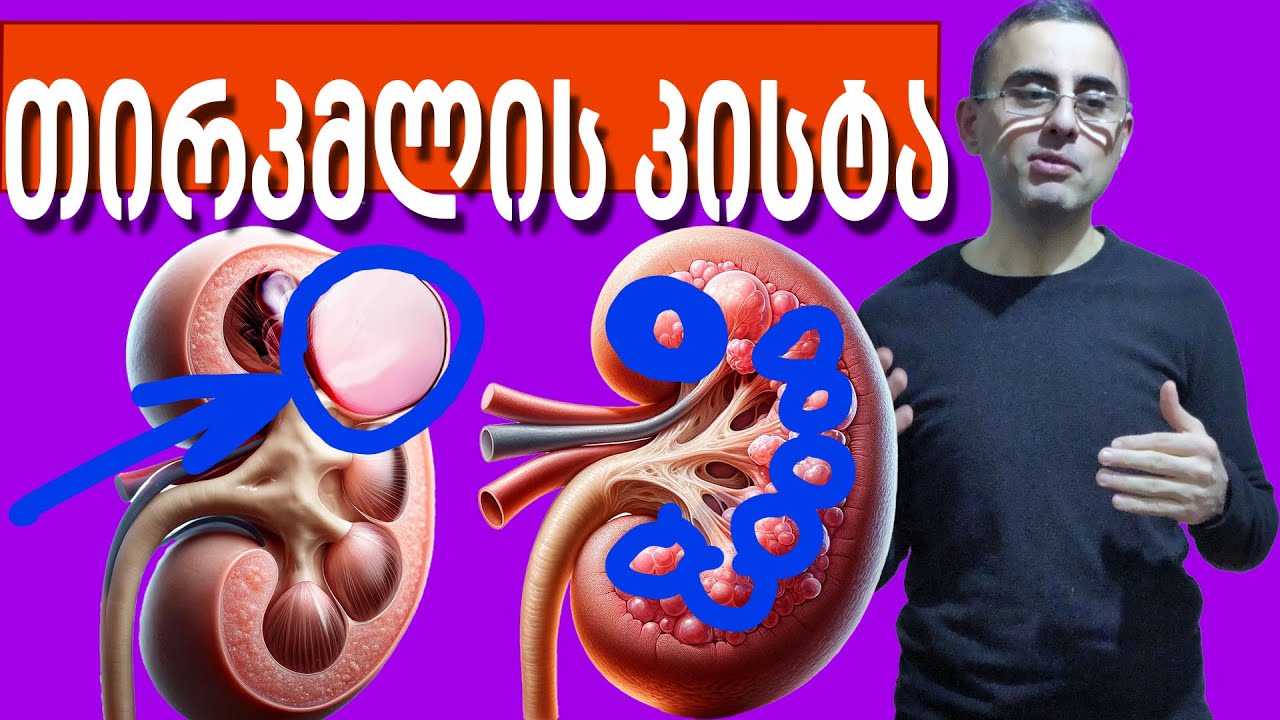 თირკმლის კისტები -  როდის უნდა მივაქციოთ ყურადღება?!
