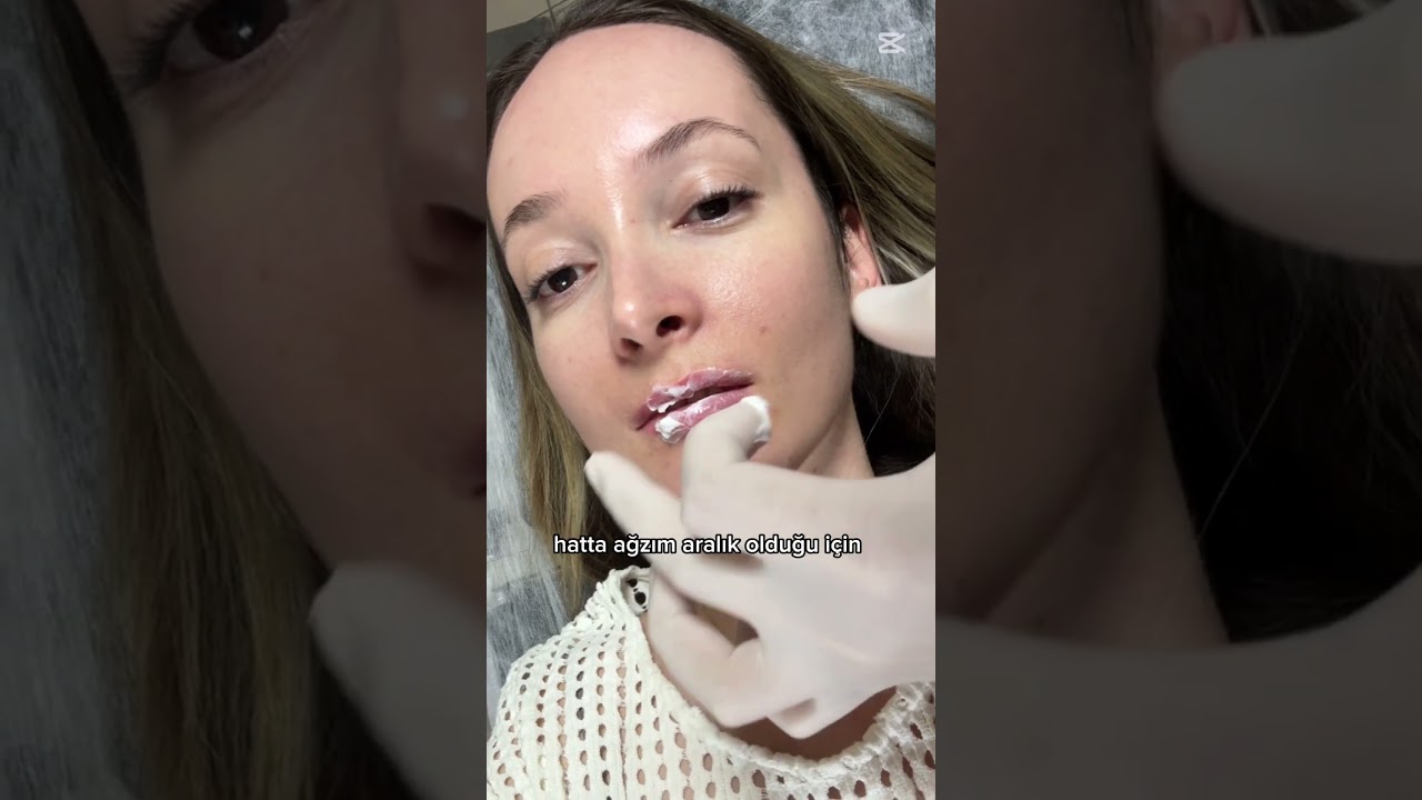 &Ccedil;&uuml;nk&uuml; neden yaptırmayayım 😬 #vlog #dudakdolgusu #dolgu #estetik #g&uuml;zellik #hemşire
