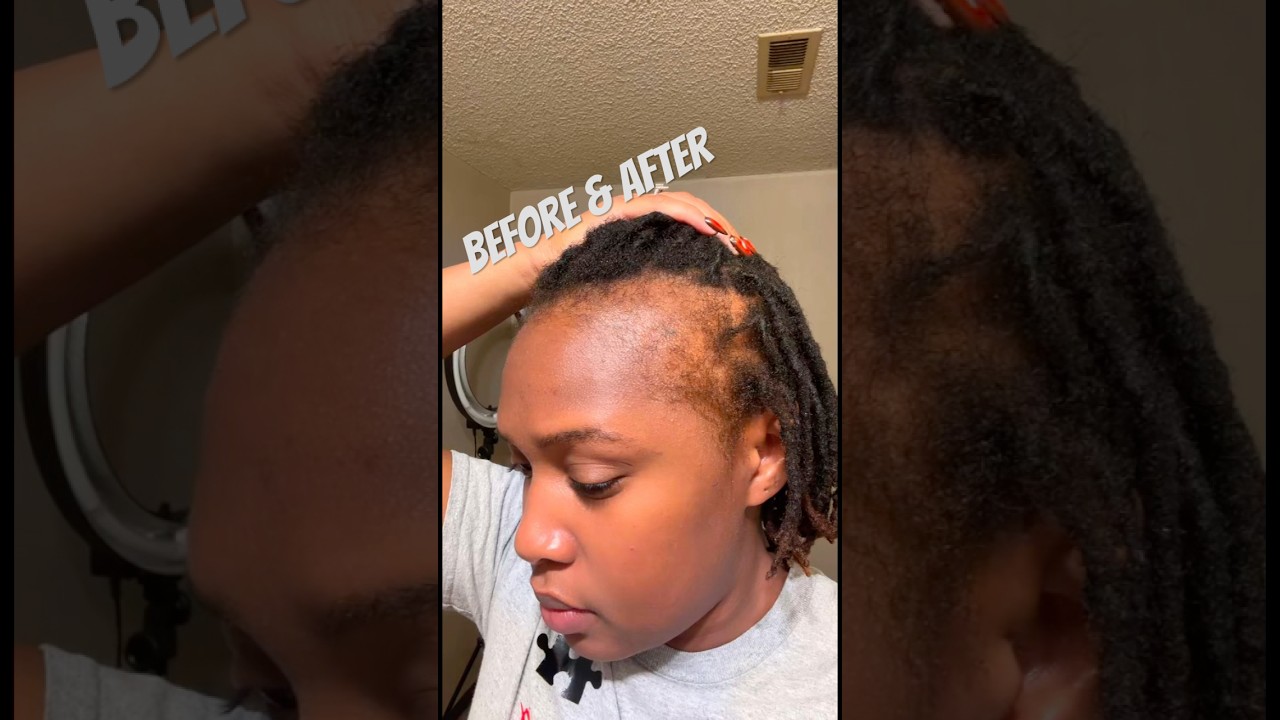 Edges are growing ! #hairgrowth #hair #edges #naturalhair #minoxidil #batanaoil