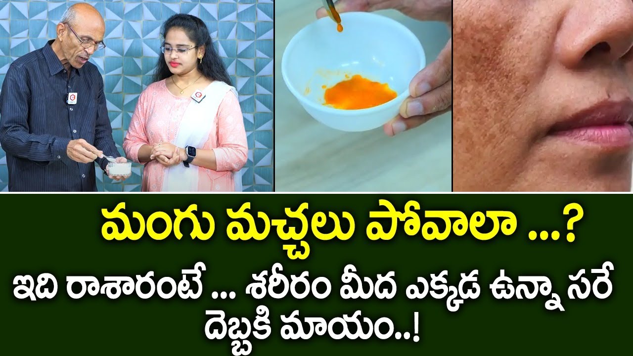 ఇది రాశారంటే మంగు మచ్చలు పోవాల్సిందే : How to Stop Pigmentation | Tips for Dark Spots on Face