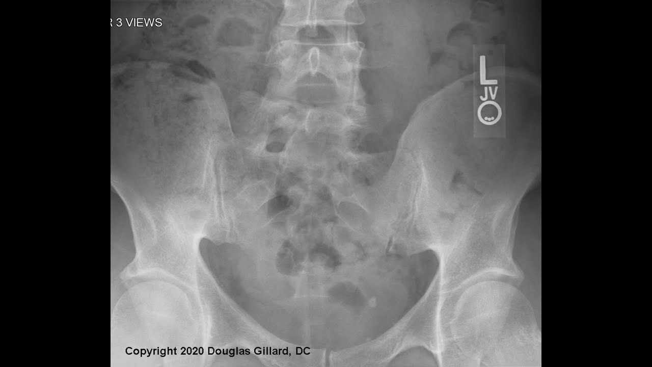 Posterior Sacral Anatomy + Two Malformations of the Lumbosacral Joint: Sacralization + Lumbarization