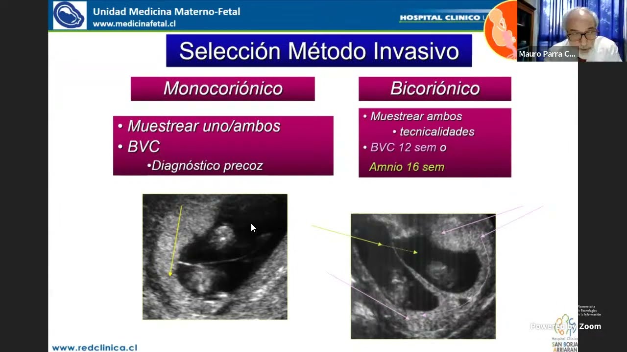 Control prenatal en embarazo gemelar (27 Jornada de MMF HCUCH)
