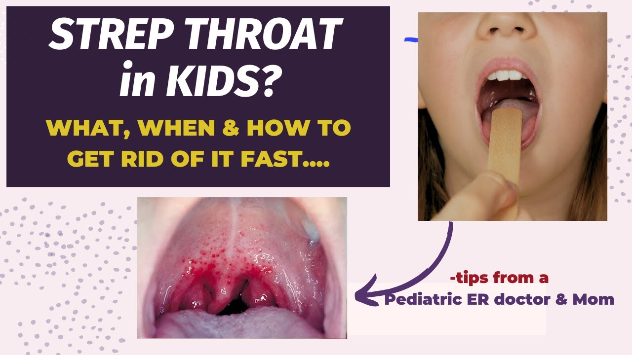 Strep Throat in Kids: How to know, When & How to treat by a Pediatrics ER doctor