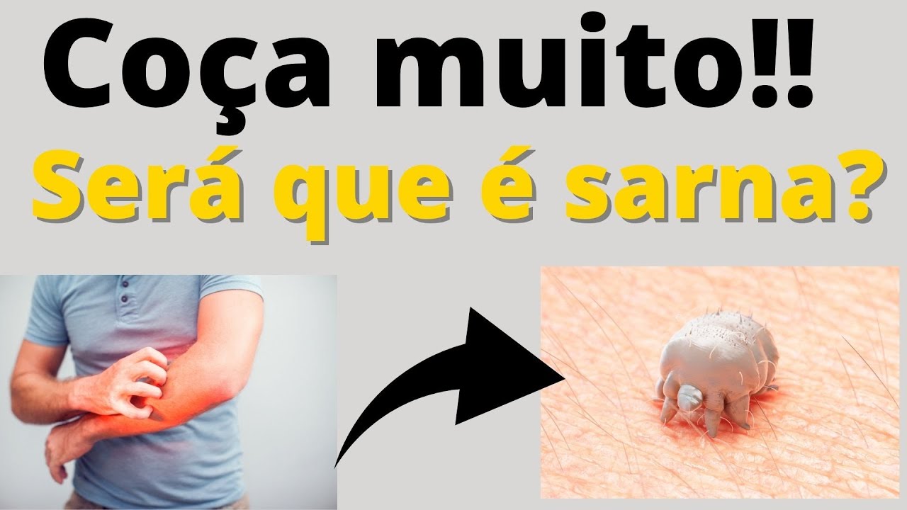 Coçando muito ? Será que é Sarna ou Escabiose , como tratar este ácaro e como peguei ? Dr. Paulo Lu