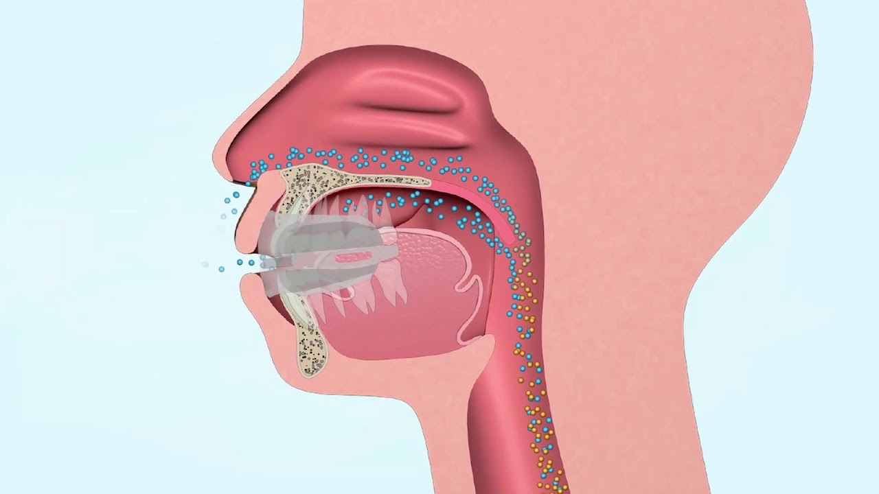 Tratamento do ronco e da apneia do sono. Sistema MyOSA.