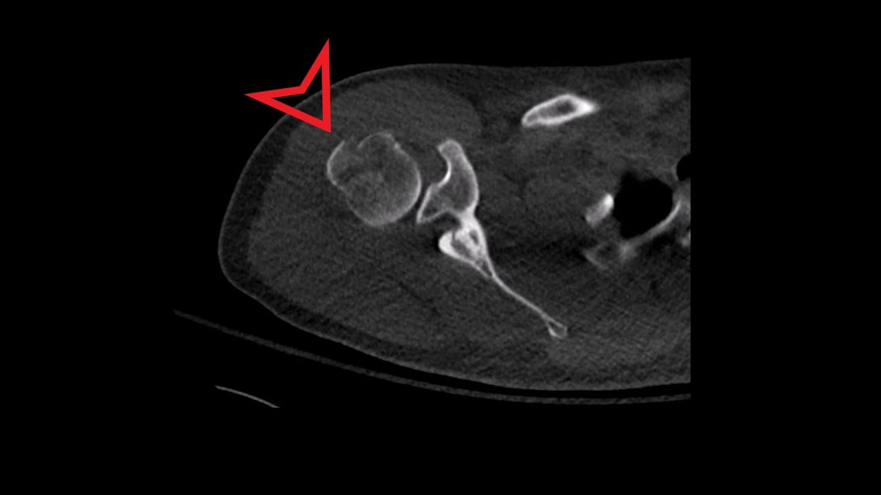 Shoulder CT: Humeral Head and Neck Fracture