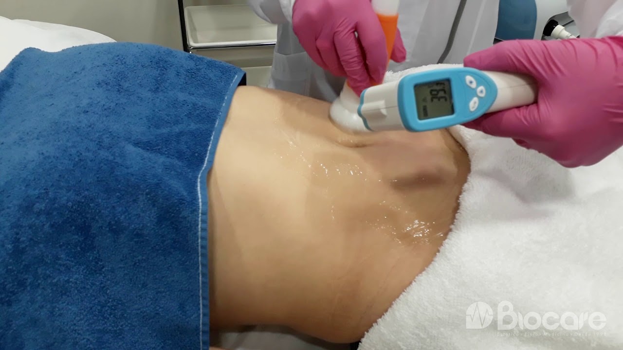 Radiofrequência Effect HTM - Protocolo corporal de Flacidez Tissular.