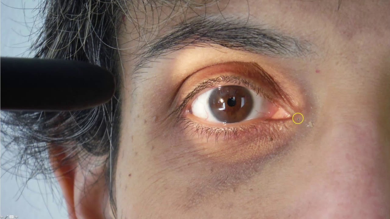 6. How to Assess the Cornea