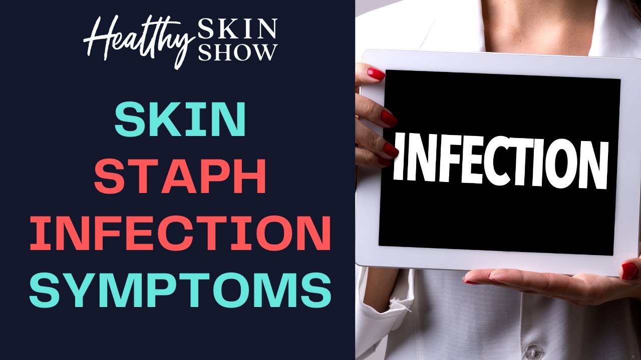 Symptoms Of A STAPH INFECTION On Your Skin | Jennifer Fugo