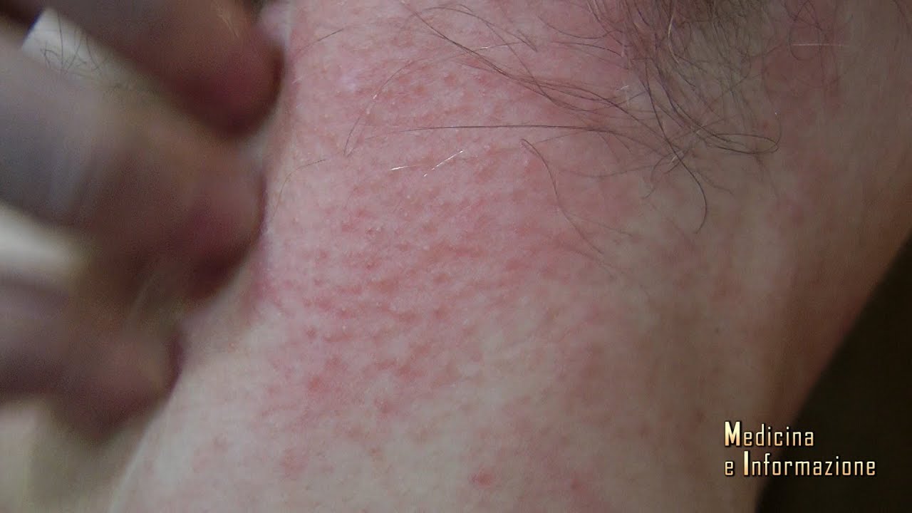 Dermatite Atopica: il disagio legato ai sintomi, le nuove terapie