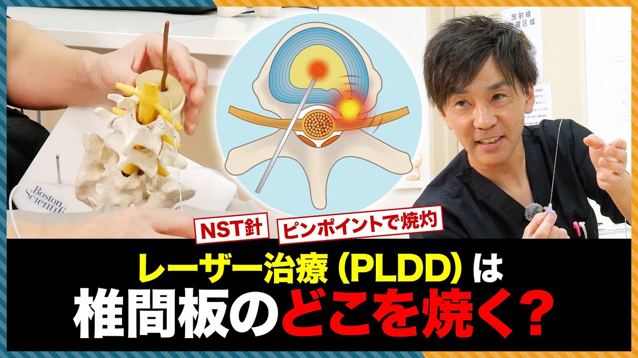 PLDD(レーザー治療)は椎間板のどこを焼く？椎間板ヘルニア治療のQ＆A