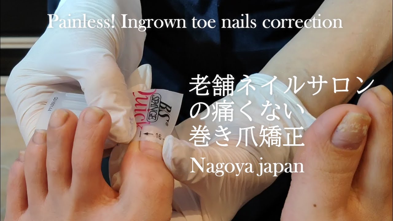 【乾燥時期に酷くなる巻爪矯正】サロンワーク施術動画　軽度の内にフットケア先進国ドイツ式のBS巻き爪矯正を試してみて。