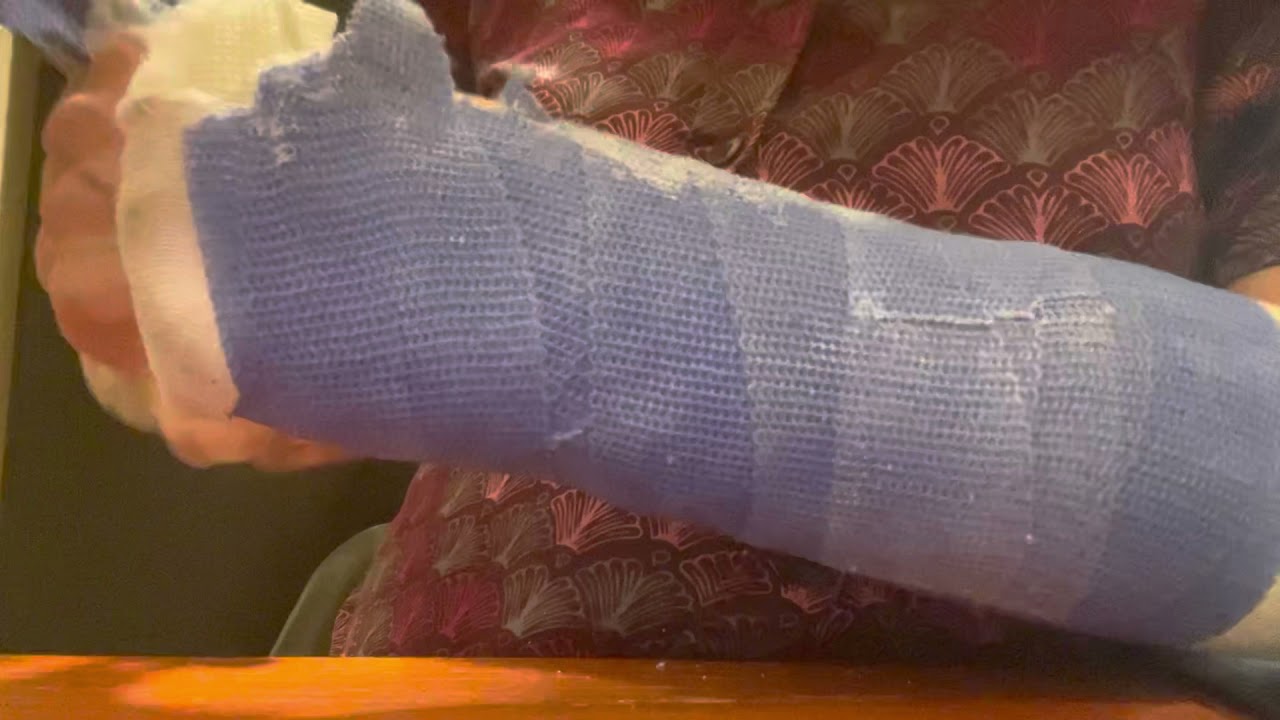 How to remove a cast at home - part 3 - after soaking it in water