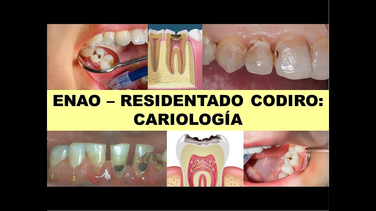 ENAO - RESIDENTADO ODONTOLÓGICO: CARIOLOGÍA