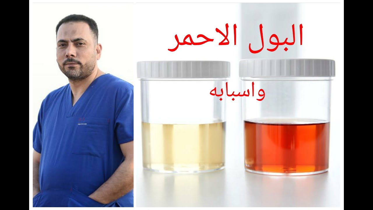 سلسله اعرف صحتك ...الحلقه الاولي (البول الاحمر )