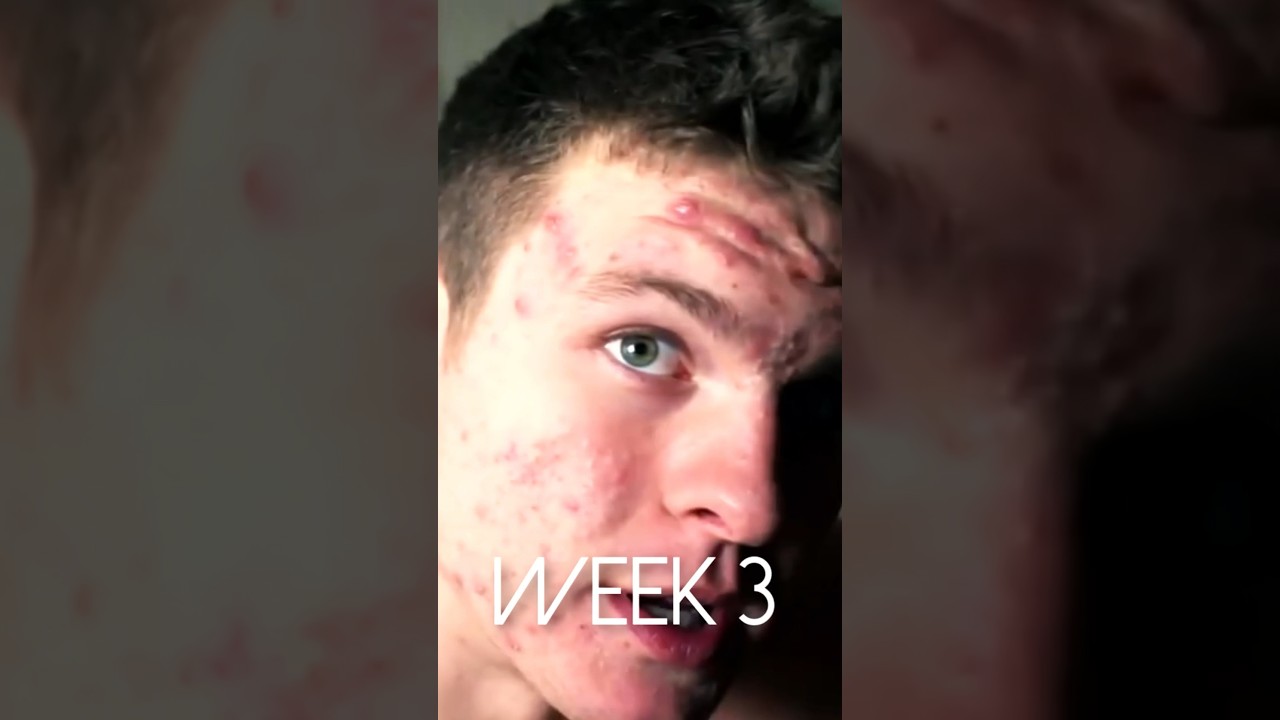 Get rid of your acne with my program TheAcneMethod.com! What happened on world's highest dose? #acne