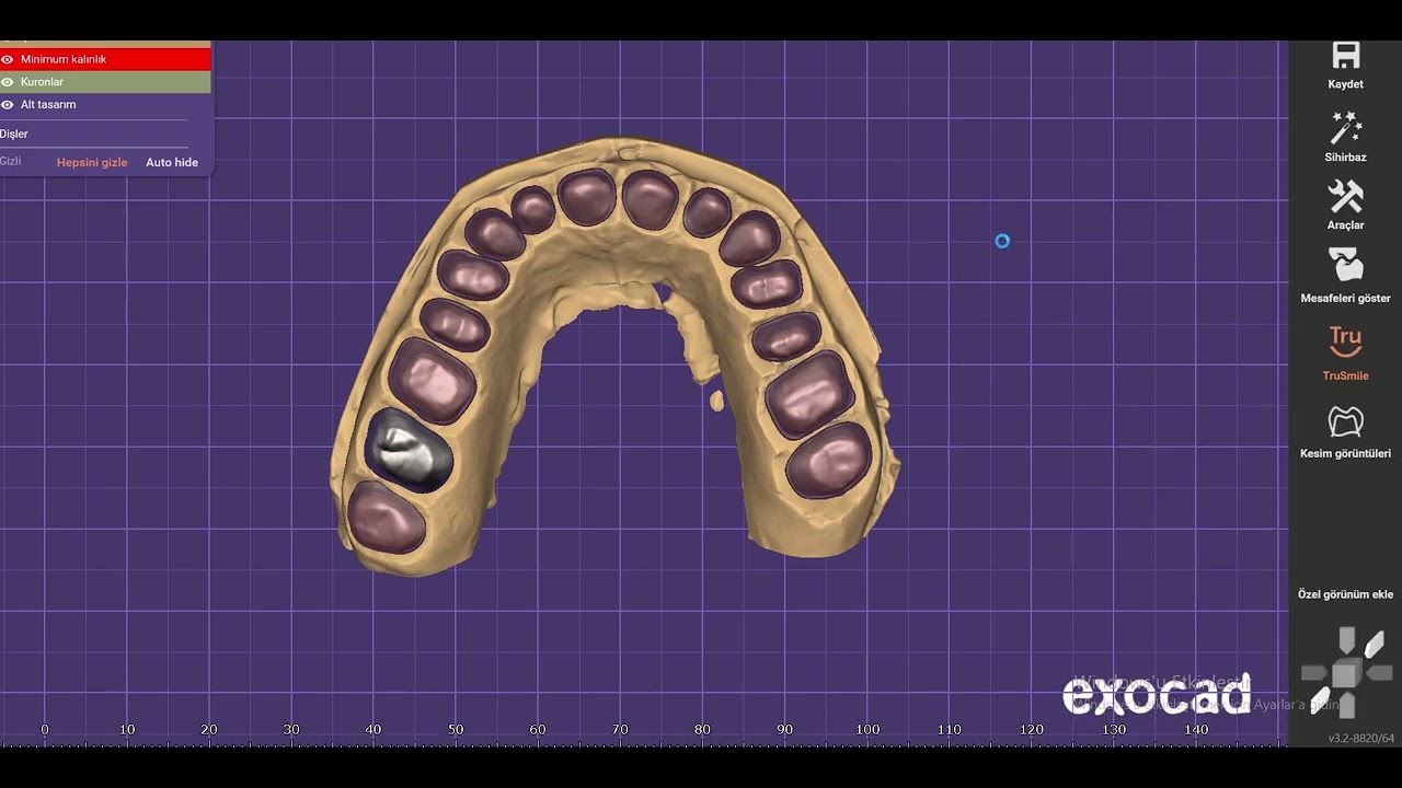 Metal Kapson alt yapı üst full köprü tasarımı || #exocad  #zirconia #cadcamdentistry#dişhekimi