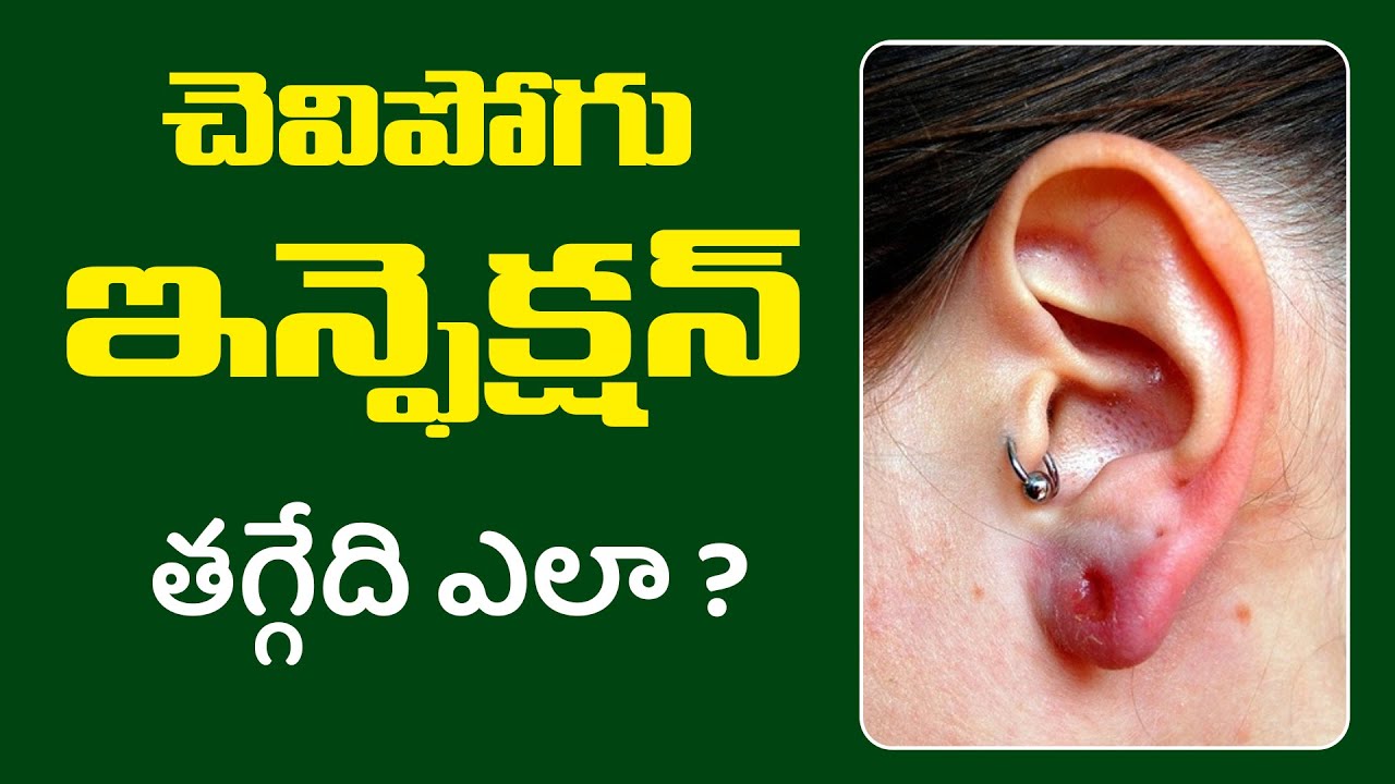 చెవిపోగుఇన్ఫెక్షన్ తగ్గేది ఎలా ? | Ear Lobe Pain & Infection | Dr. Pavushetty Sreedhar