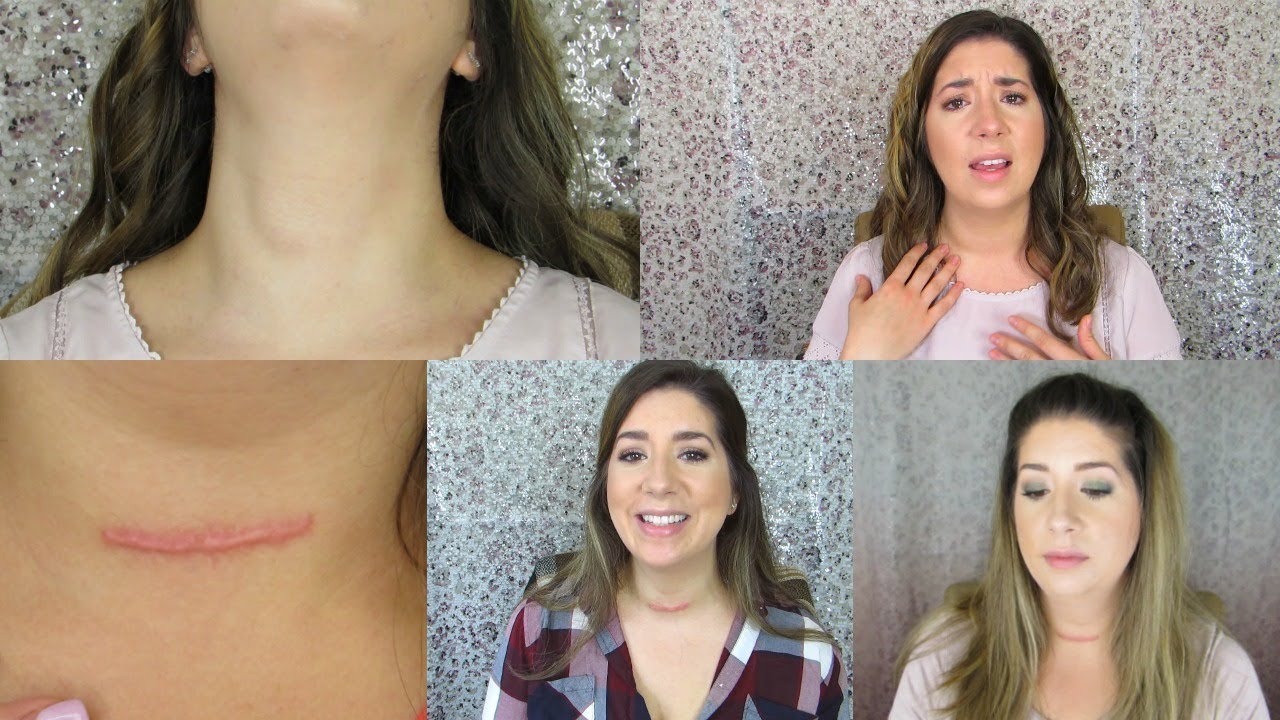 One Year Post Thyroidectomy | Thyroid Cancer Journey