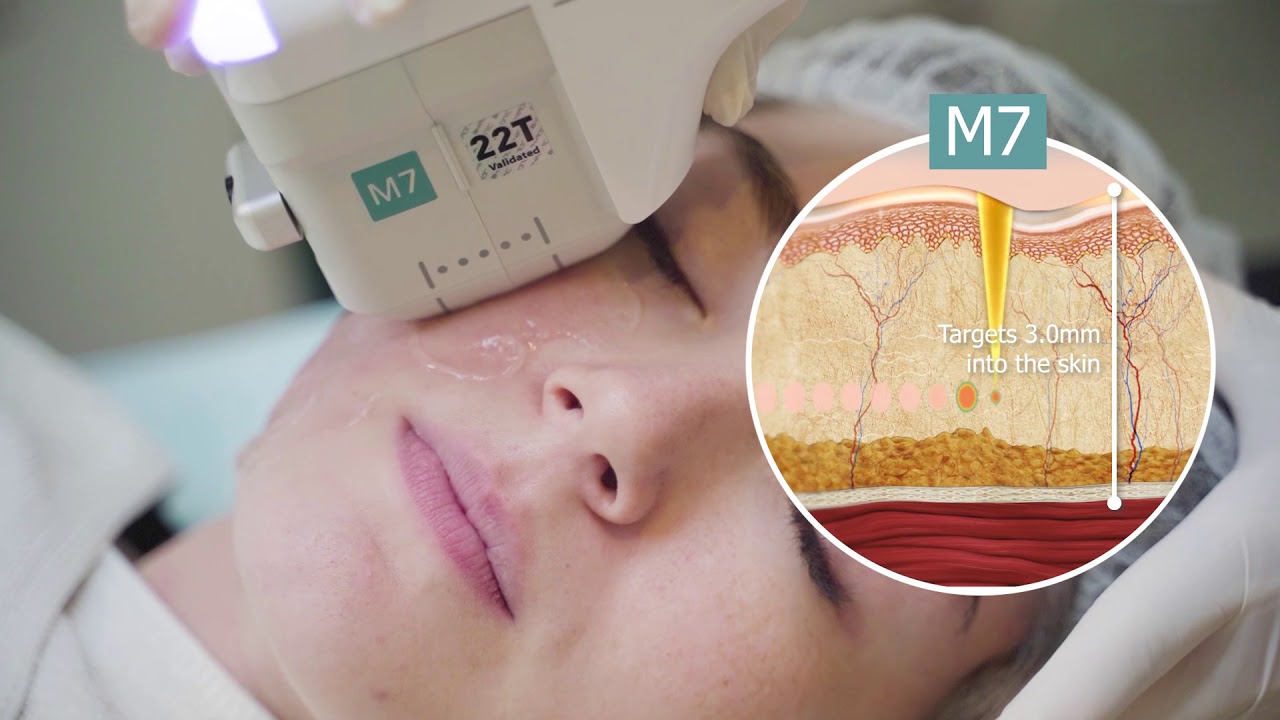 Doublo Gold HIFU at Cambridge Medical Group by Dr Lee Mun Heng