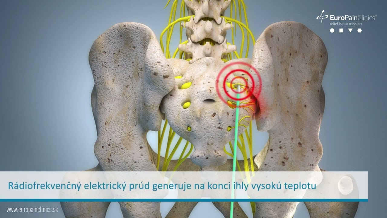 Rádiofrekvenčná denervácia sakroiliakálneho (SI) kĺbu