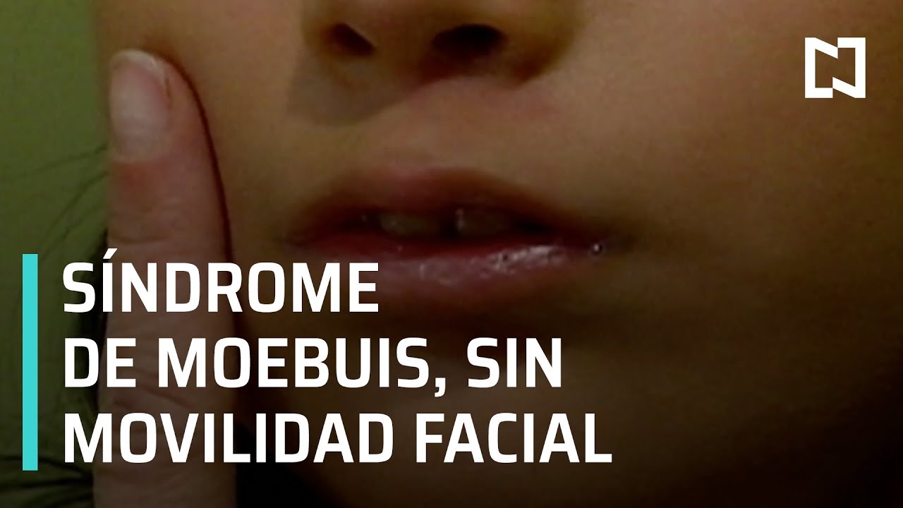 Síndrome de Moebius - Las Noticias