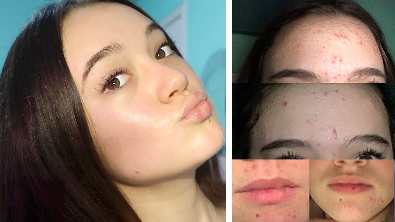 Мой ежедневный уход за кожей (от акне к чистой коже) ... FionaFrills Vlogs