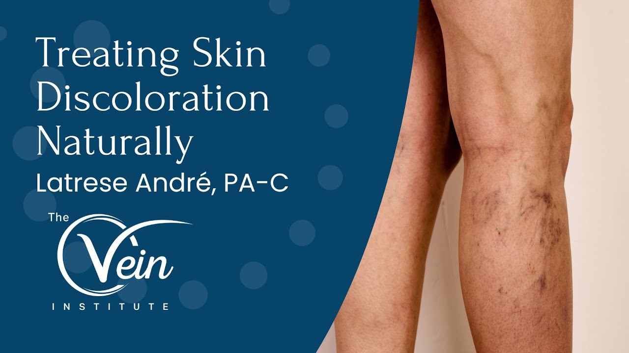 Treating Skin Discoloration Naturally | Latrese Andre, PA-C