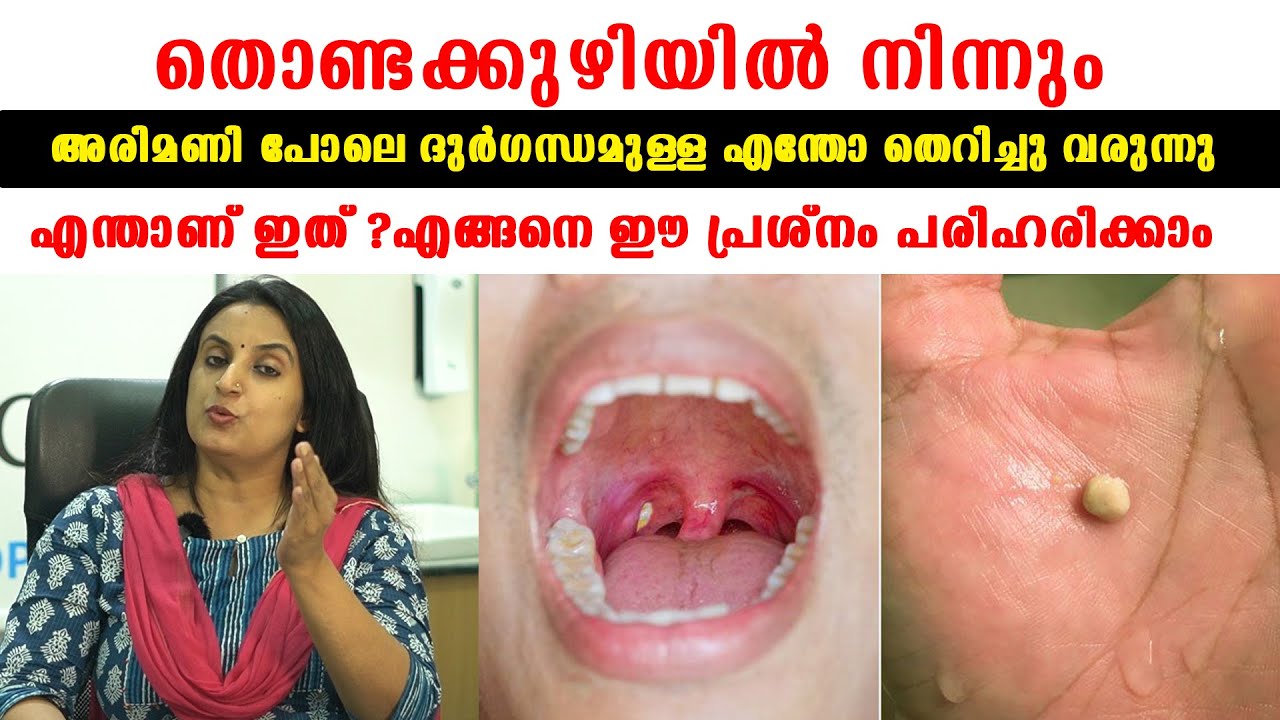 വായില്‍ നിന്നും  നിന്നും അരിമണി പോലെ ദുർഗന്ധത്തോടെ തെറിച്ചു വരുന്നത് എന്താണ് ?പരിഹാരം /Baiju's Vlogs