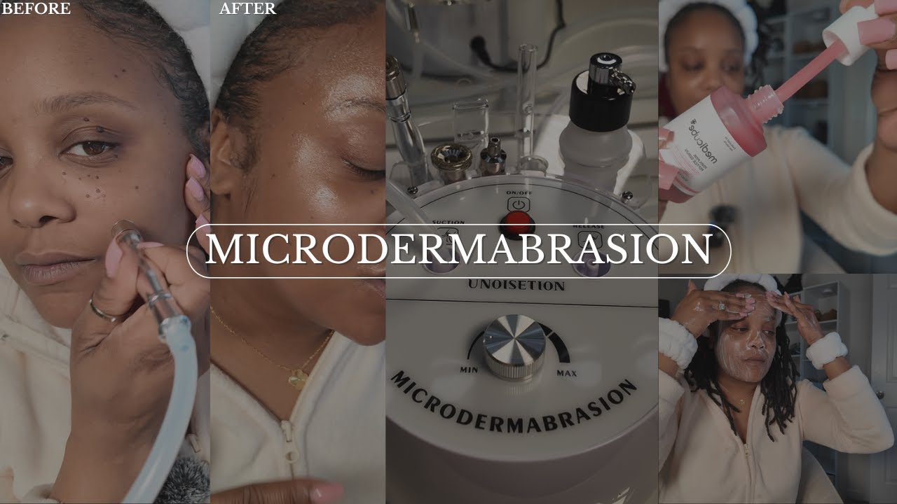 ACHIEVE FLAWLESS SKIN: MICRODERMABRASION MACHINE & FACIAL TUTORIAL! DIY Beauty Maintenace