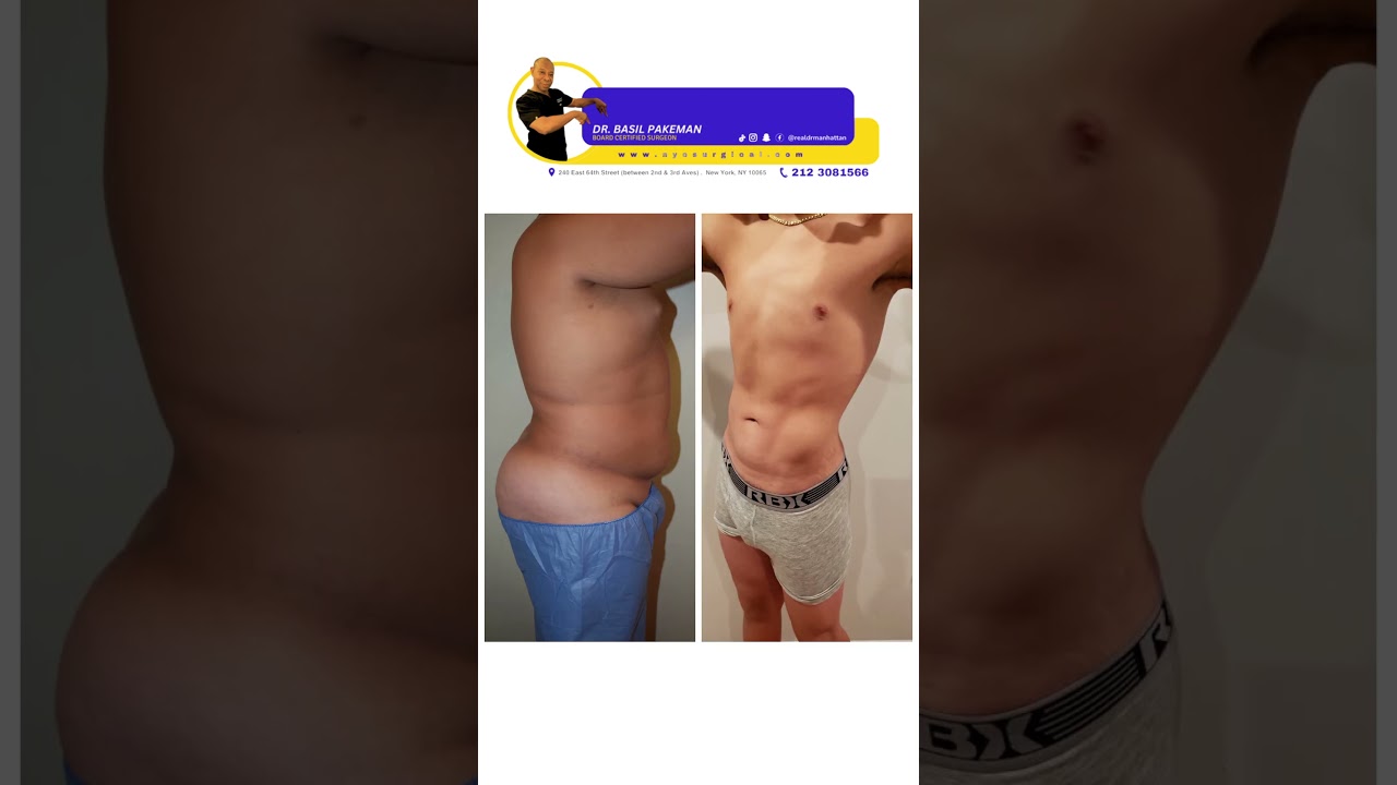 High Definition Liposuction