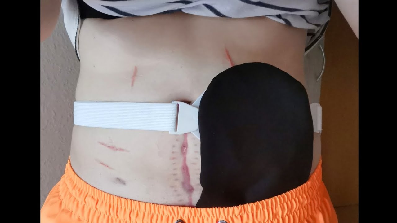 Stoma | Gürtel | Bandagen | Anwendung