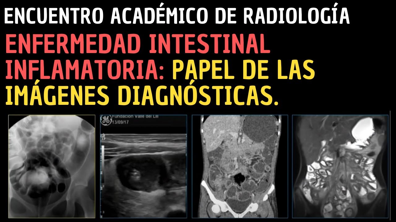 IX Encuentro Académico de Radiología: Enfermedad intestinal inflamatoria.