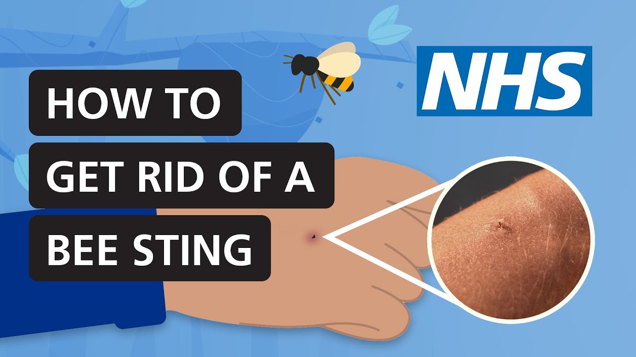 How to get rid of a bee sting | NHS