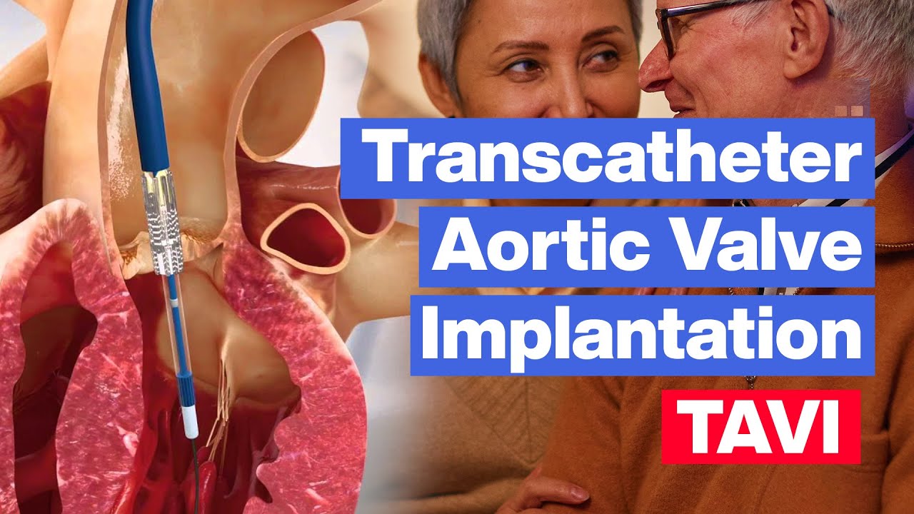 Transcatheter Aortic Valve Implantation (TAVI) 💔 عملية تغيير الصمام الأورطي عن طريق القسطرة