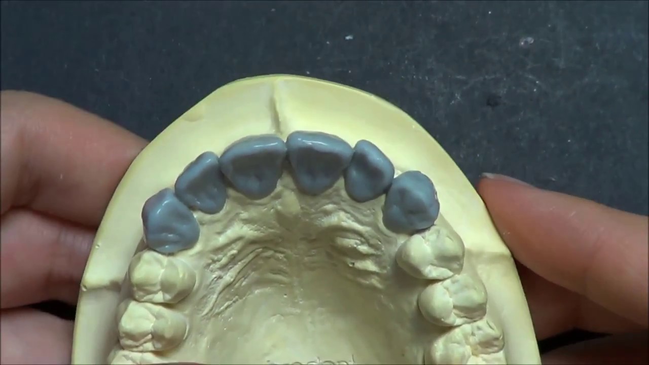 Live wax up - Upper Anterior bridge 2