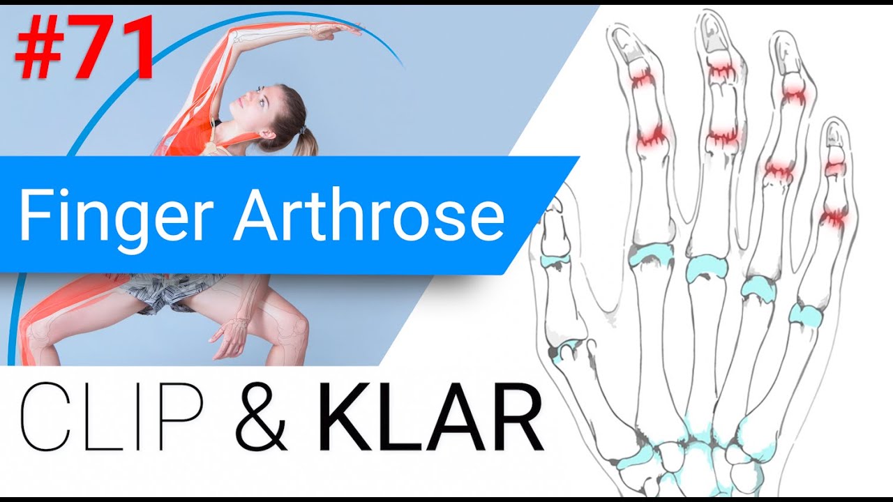 Finger Arthrose erkl&auml;rt - Kleine Gelenke, grosse Einschr&auml;nkung