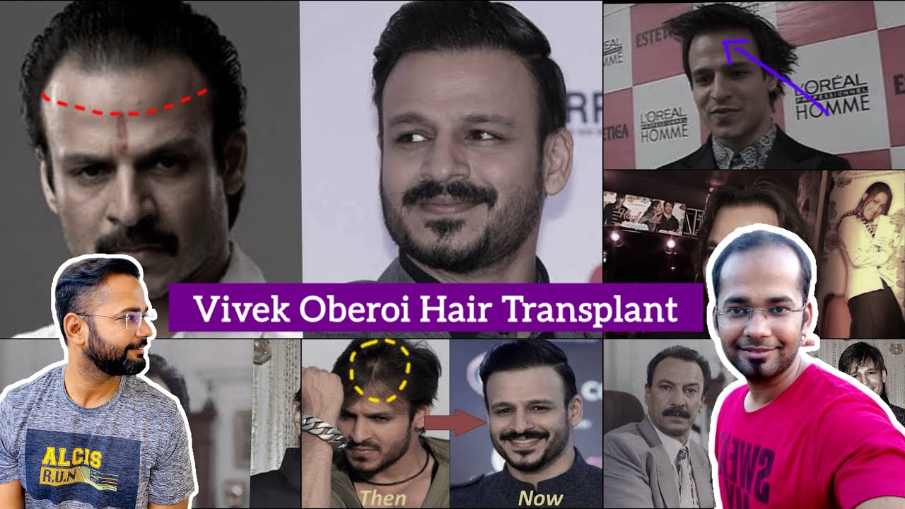 Vivek Oberoi Hair Transplant Surgery in Delhi | Bollywood Actors Hair Transplant Result