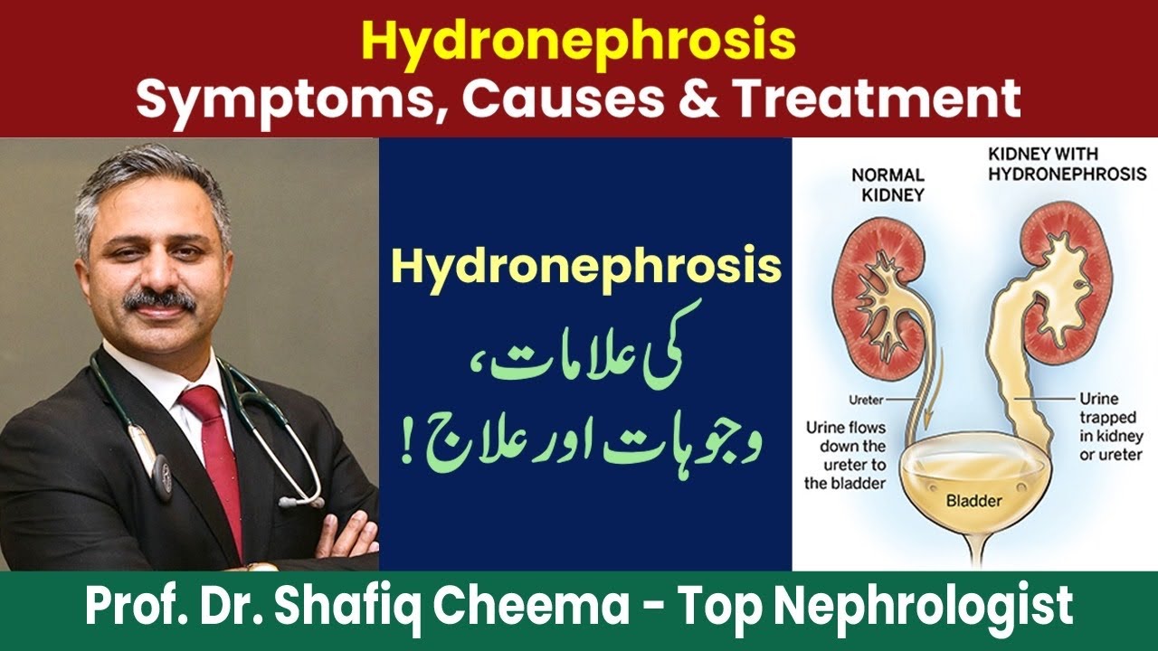 Hydronephrosis Symptoms, Causes & Treatment