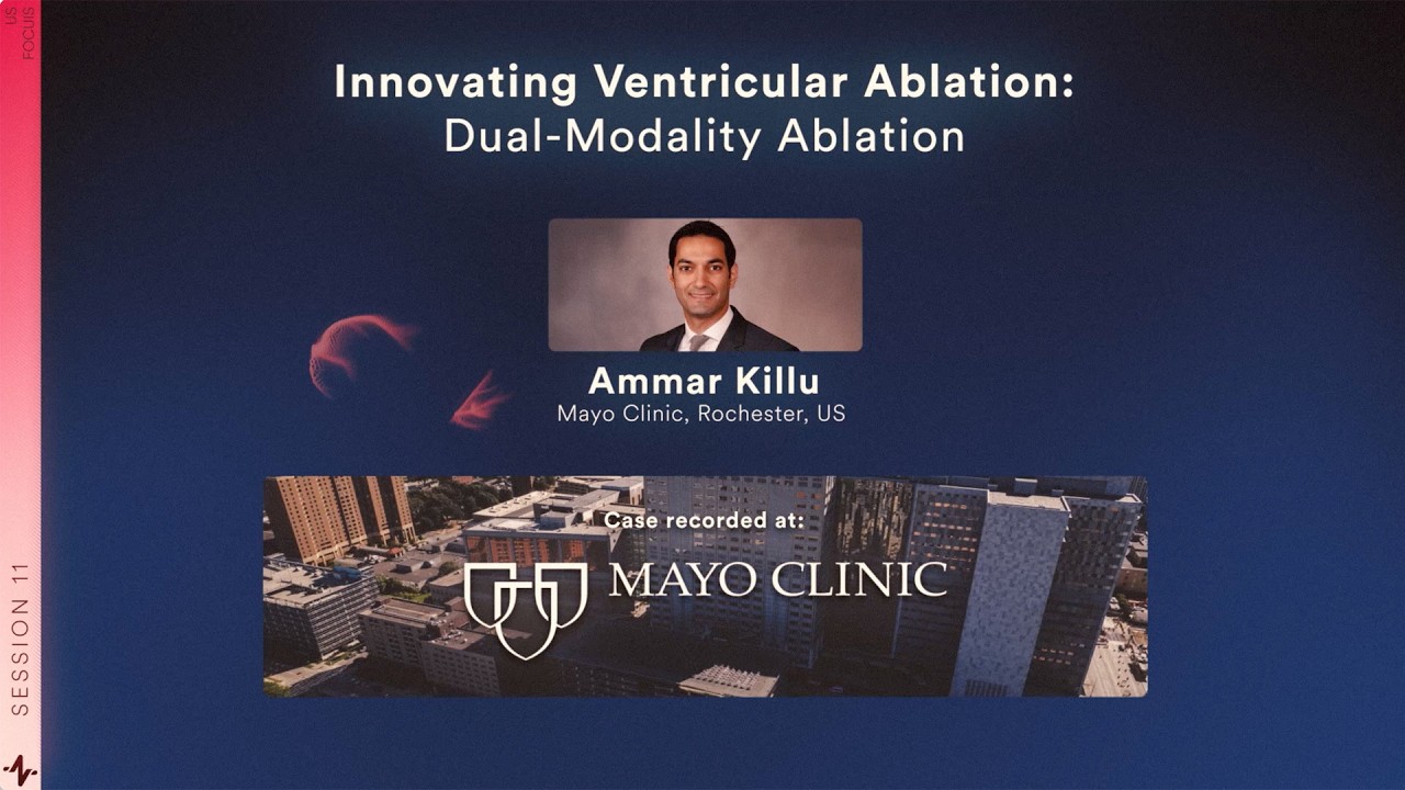 RIO 2025 | Case & Discussion: Innovating Ventricular Ablation: Dual-Modality Ablation