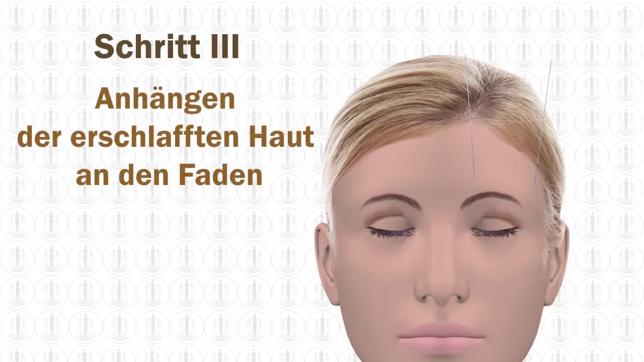Fadenlifting der Augenbrauen in Berlin bei Juri Kirsten