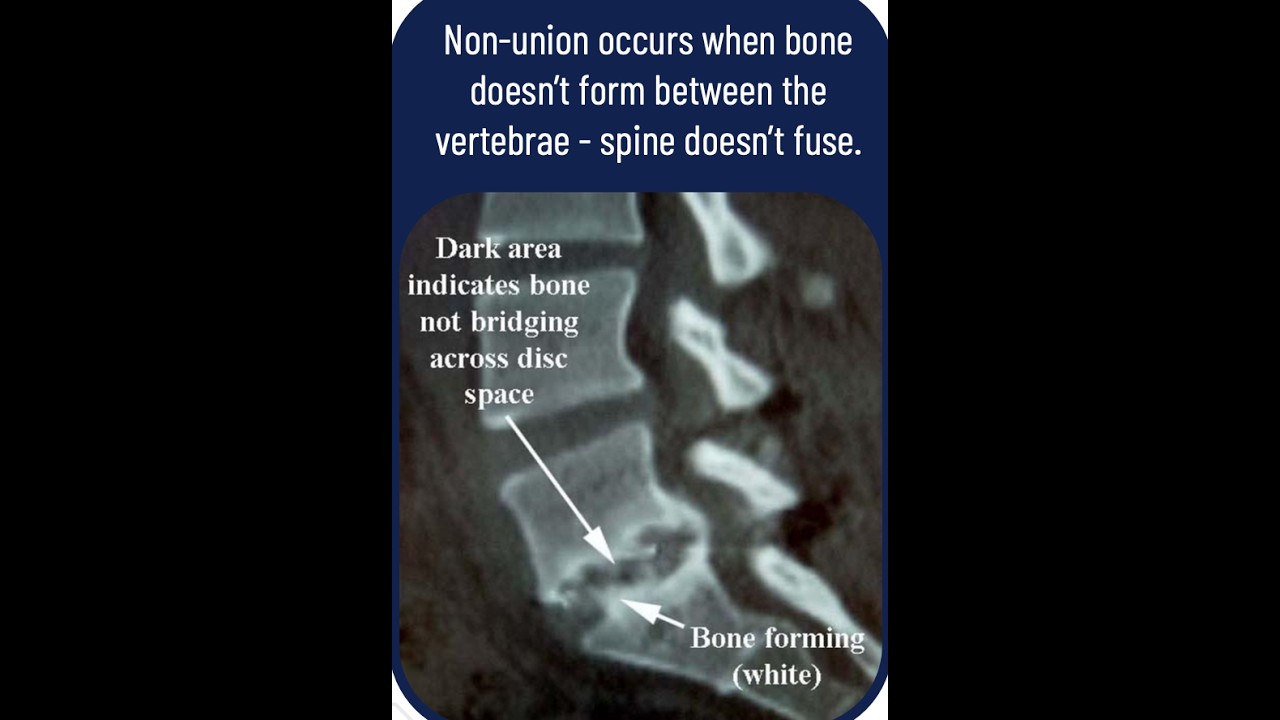 Bone Growth Stimulators, should I use one , how they work , how long do I need to wear it ?